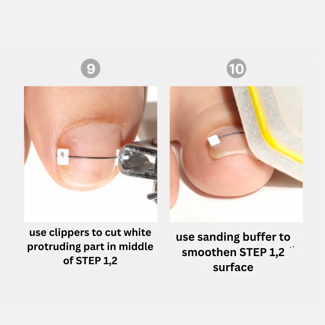 CORRECTOR - INGROWN NAIL TREATMENT