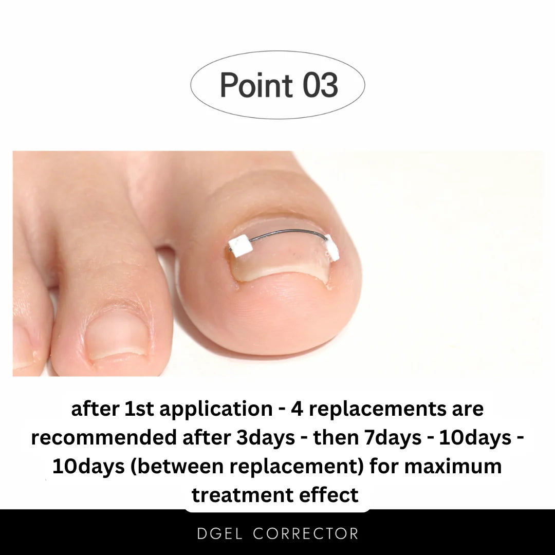 CORRECTOR - INGROWN NAIL TREATMENT
