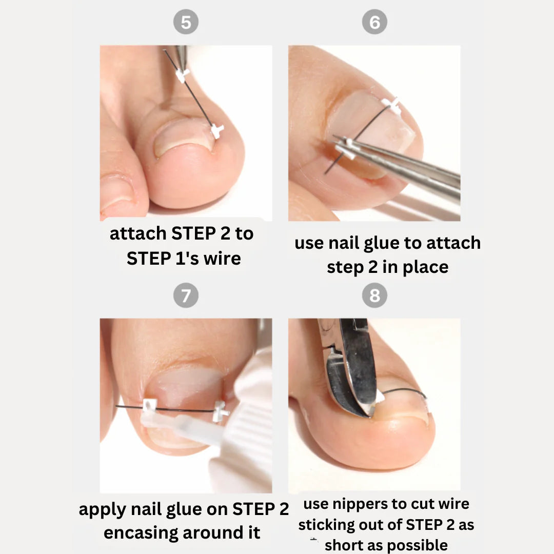 CORRECTOR - INGROWN NAIL TREATMENT